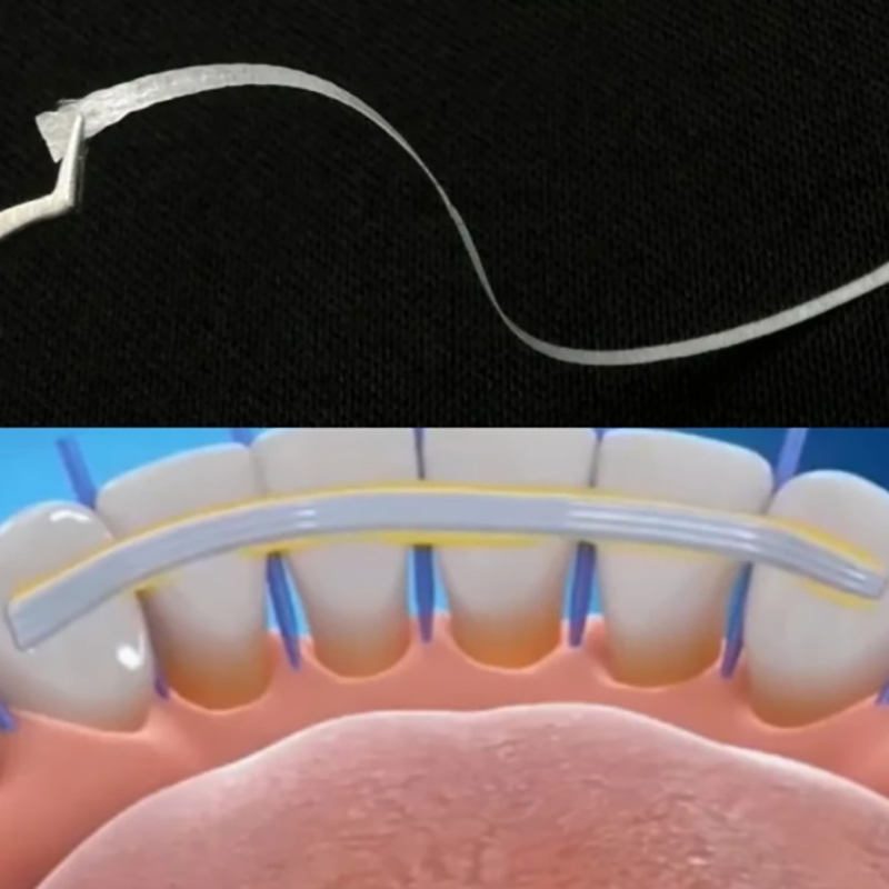 1/5Pcs Glass Splint Loose Toot - Teeth Whitening Laser ulasan dan harga