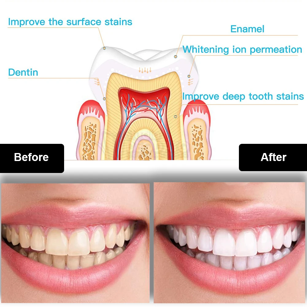 Dental Teeth Whitening Kit Min - Teeth Whitening Laser ulasan dan harga